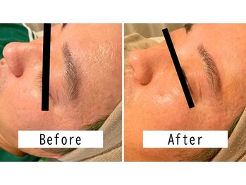 癒し～ぷアイラックス 名古屋店の写真/つるんと明るい毛穴レスの滑らか肌に〈フェイスワックス全顔¥4980〉ヘッドスパとSET¥1980キャンペーンも◎