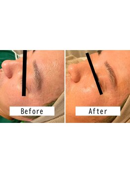 顔脱毛がしたい