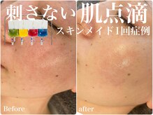 アリィ(Alii hisaya)の雰囲気（【トロイアルケ】刺さない肌点滴で毛穴レス肌へ♪）