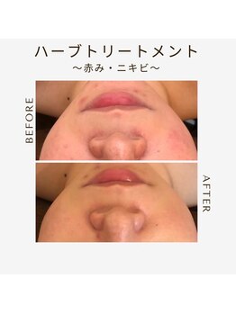 ツヤハダコガオ 千葉店/before⇒afterハーブピーリング