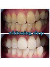 ホワイトニングショップ 武蔵小杉店/武蔵小杉ホワイトニング美白ケア