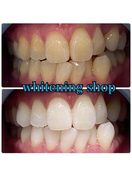 ホワイトニングショップ 武蔵小杉店/武蔵小杉ホワイトニング美白ケア