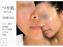 サロン ド パーフェクション(Salon de Perfection)/無針水光導入