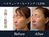 OPEN記念 筋膜ハイウェーブ×肌悩み別ピーリング×LDM ¥29,000→¥15,000