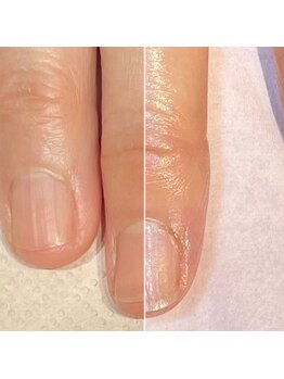 ココデネイル(cocode nail)/悩み:二枚爪(50代前半)