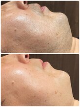 エスケア(S-CARE)/ヒゲ脱毛でストレスフリーに！！