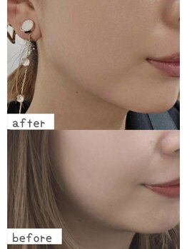 トモズサロン28(Tomos.salon.)/たるみ改善・小顔・リフトアップ