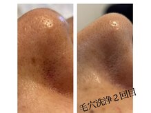 スムース イー(Smooth+E)/毛穴洗浄効果