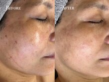 イースト(EAST)/シミプラズマフルコース8回