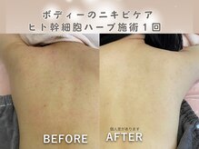 ビカオ(BIKAO)/ハーブピーリング