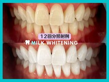 ミルクホワイトニング 長崎中央橋店(Milkホワイトニング)/◆施術例