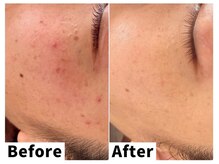 ナトゥーラ チュチュ(natura chuchu)/肌荒れ・ニキビケア★大阪梅田