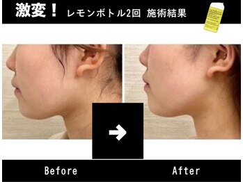 アテ 国分寺店(Ate)の写真/韓国で話題の脂肪分解×最新痩身機器の最強タッグで脂肪、浮腫スッキリ★