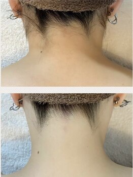 エレヌイ(ELENUI)/美肌脱毛★最新脱毛機器