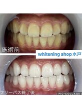 ホワイトニングショップ 水戸駅前店/#水戸ホワイトニング#水戸エステ