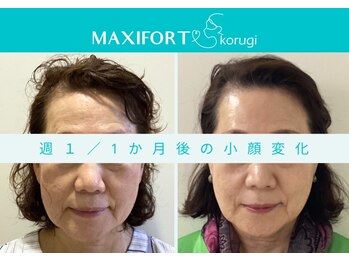 コルギ専門店 マキシフォート 栄店(Maxifort)/週1 / 1ヶ月後の小顔変化