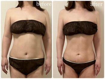 リリィブラン(Lily branc)/【痩身】上半身/お腹+ウエスト