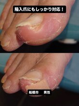 巻き爪じゅん 船橋店/陥入爪の痛みと向き合う