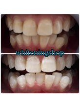 ホワイトニングショップ 武蔵小杉店/武蔵小杉ホワイトニング美白ケア