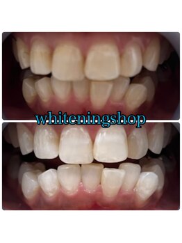 ホワイトニングショップ 武蔵小杉店/武蔵小杉ホワイトニング美白ケア