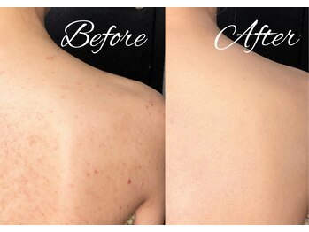 アモリール(Amolir)/ブライダルお背中ケア