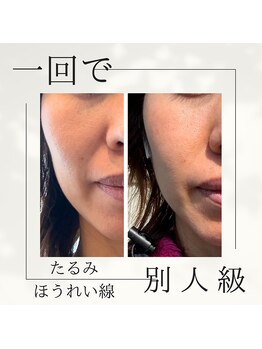 アクアリジェ/ほうれい線が1回でなくなった?!