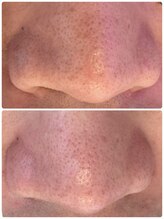 フェニーチェ 高崎(FENICE)/ハイドラフェイシャル