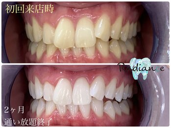 札幌セルフホワイトニング ラディアンス(Radiance)/ホワイトニング2か月間通い放題