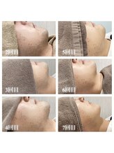 リノア(Linoa)/ヒゲ脱毛経過写真