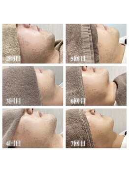 リノア(Linoa)/ヒゲ脱毛経過写真