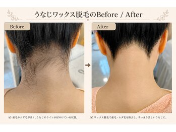 キアラ 麻布十番(Kiara)/うなじワックス脱毛BeforeAfter