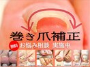 巻き爪補正