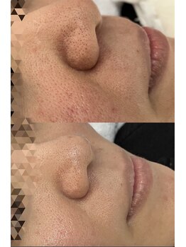 エリー(ERIE)/ハーブピーリングで毛穴ケア