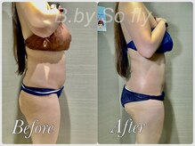 ビードット バイ ソーフライ(B.by So fly)/結果重視！脂肪取り痩身☆