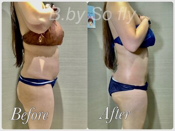 ビードット バイ ソーフライ(B.by So fly)/結果重視！脂肪取り痩身☆