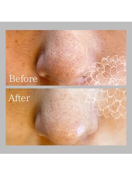 ダリア(DAHLIA)/ハイドラフェイシャル