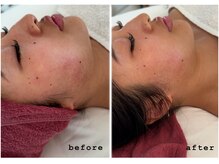 インディバ 恵比寿(INDIBA)/インディバ×ハーブピーリング