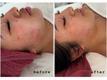 インディバ 恵比寿(INDIBA)/インディバ×ハーブピーリング