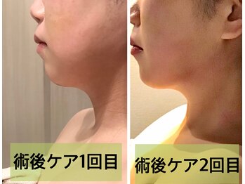 インディバ ミマリ(INDIBA ミマリ)/術後ケア頬と顎下