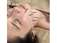 ロウエン(LAUEN)の雰囲気（当サロン独自の美容鍼技術で圧倒的な効果をご実感頂けます）