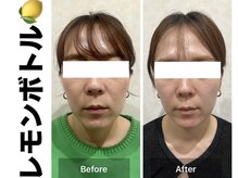 ブレア(Blair)/脂肪分解/レモンボトル