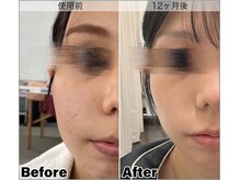 ベルミーランド マルエツ安行慈林の雰囲気（話題の幹細胞美容を日常に。使用前→1ヶ月後）