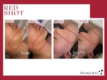 リーインカーナ アーティスト(REINCARNA ARTIST)の雰囲気(脂肪分解美容液レッドショット●エイジング効果(小顔たるみケア))