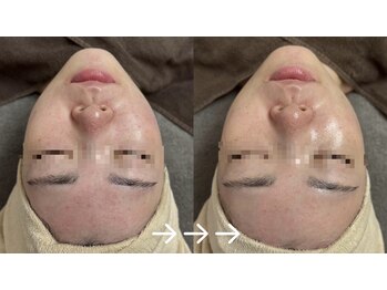 フローラスキン 恵比寿Amour店(florasKIN)/肌質改善(水光注入)