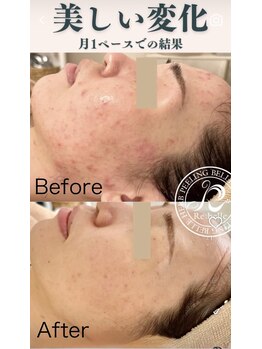 SDルーム/リベルハーブ　肌質改善