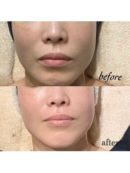 ピアーノ(PIANO)/エルモサハーブピーリング