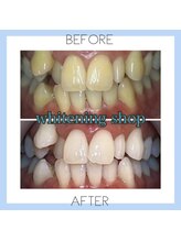 ホワイトニングショップ 芦屋店/お客様のビフォーアフター♪