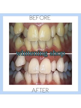 ホワイトニングショップ 芦屋店/お客様のビフォーアフター♪