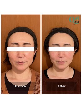 キュープ 前橋店(Qpu)/小顔頭蓋骨矯正+美肌美顔器 4回