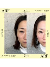 アーフ(ARF)/エクソリフト